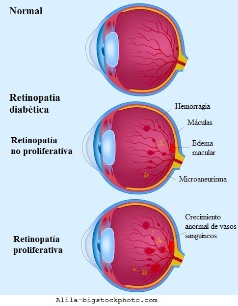 Retinopatia diabética