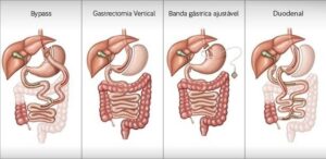 A obesidade é uma condição cada vez mais comum, levando muitos pacientes a questionarem se são candidatos à cirurgia bariátrica. Esta cirurgia é uma opção de tratamento para obesidade, oferecendo uma perda de peso mais significativa em comparação com medicamentos e mudanças no estilo de vida. No entanto, é crucial avaliar cuidadosamente quais pacientes se beneficiarão realmente deste procedimento e se não possuem contraindicações.