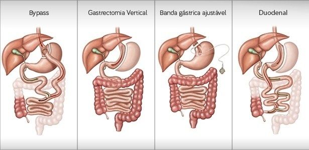 Tipos de procedimentos da cirurgia bariátrica