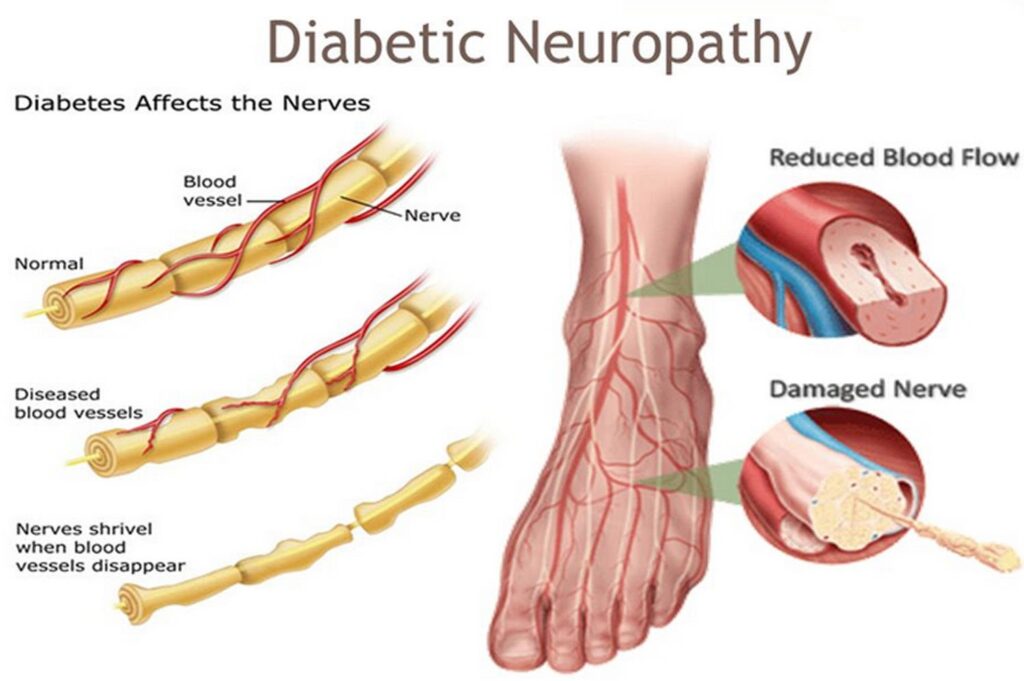 Neuropatia diabética